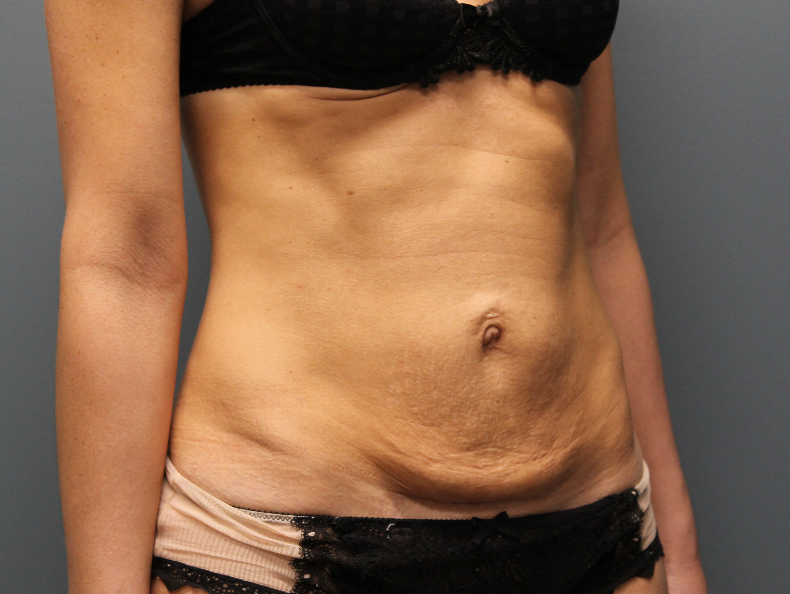 Tummy Tuck Patient Photo - Case 2913 - before view-
