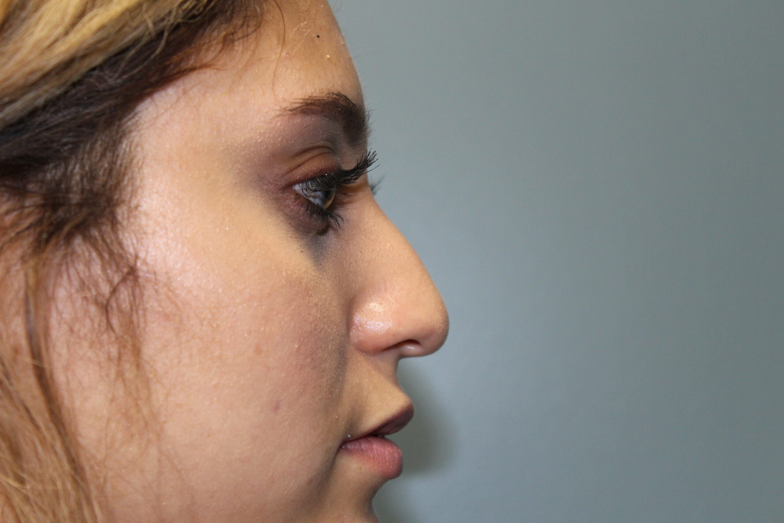 Rhinoplasty Patient Photo - Case 3088 - before view-0
