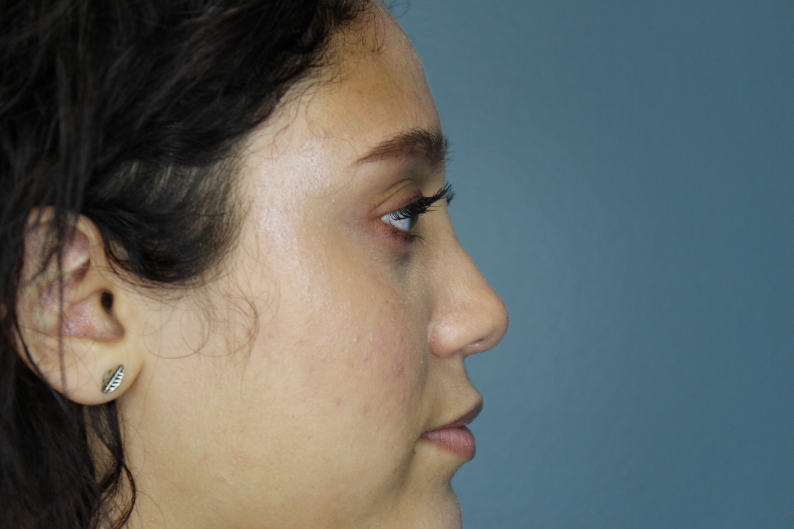 Rhinoplasty Patient Photo - Case 3088 - after view-0