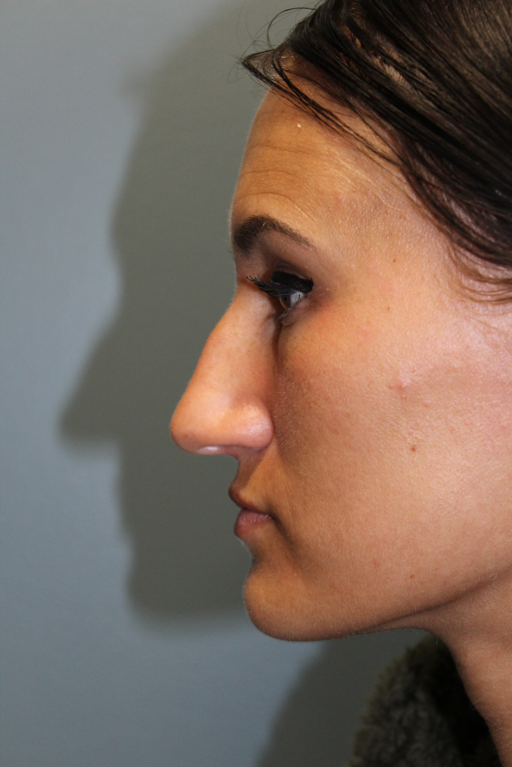 Rhinoplasty Patient Photo - Case 3100 - before view-0