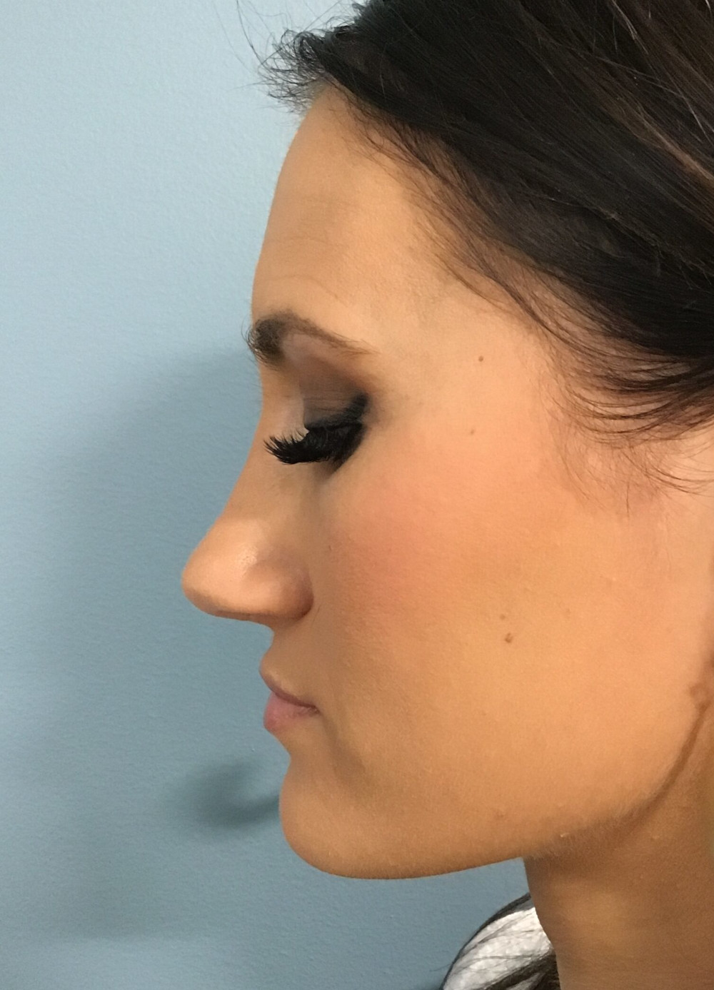 Rhinoplasty Patient Photo - Case 3100 - after view