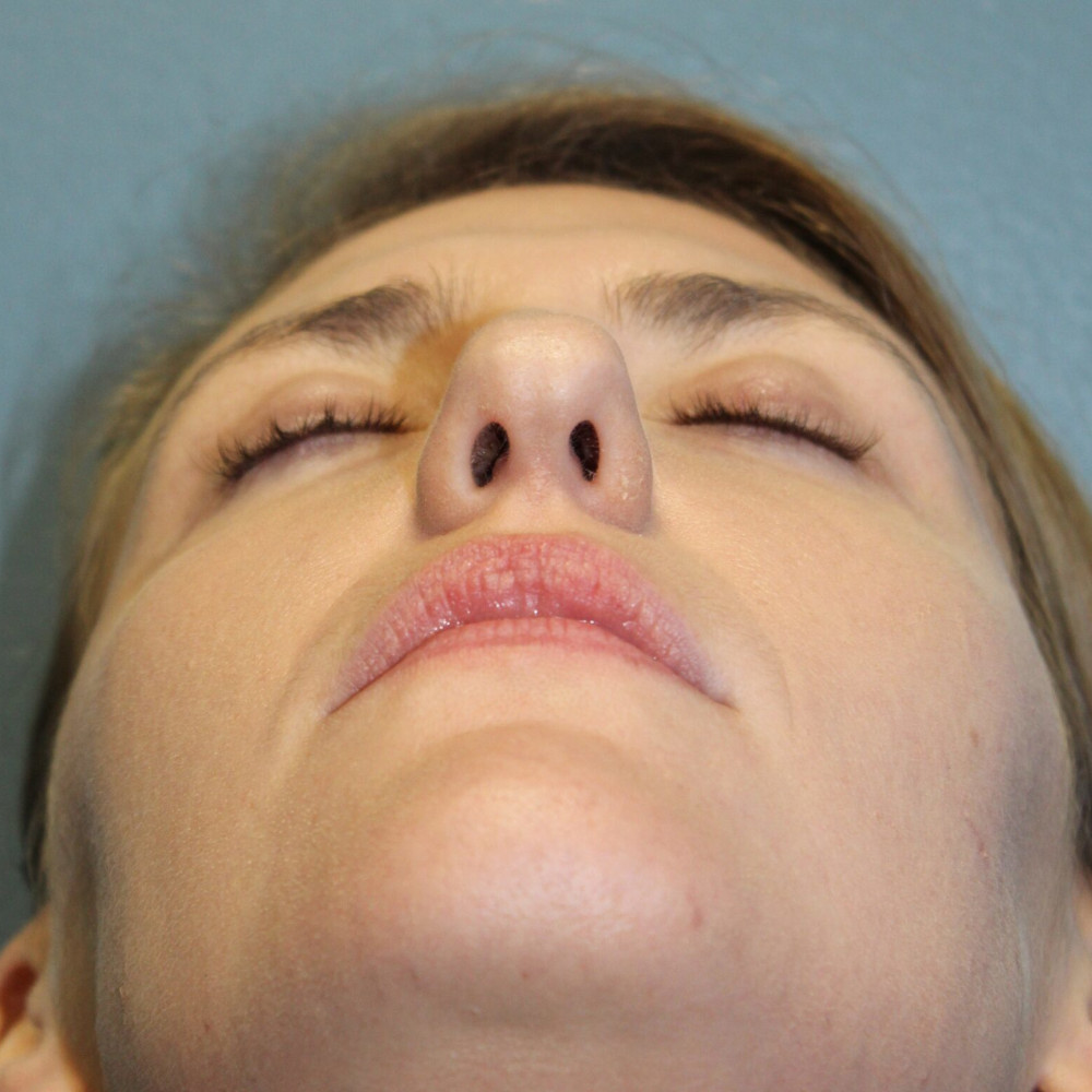 Rhinoplasty Patient Photo - Case 3103 - before view-0