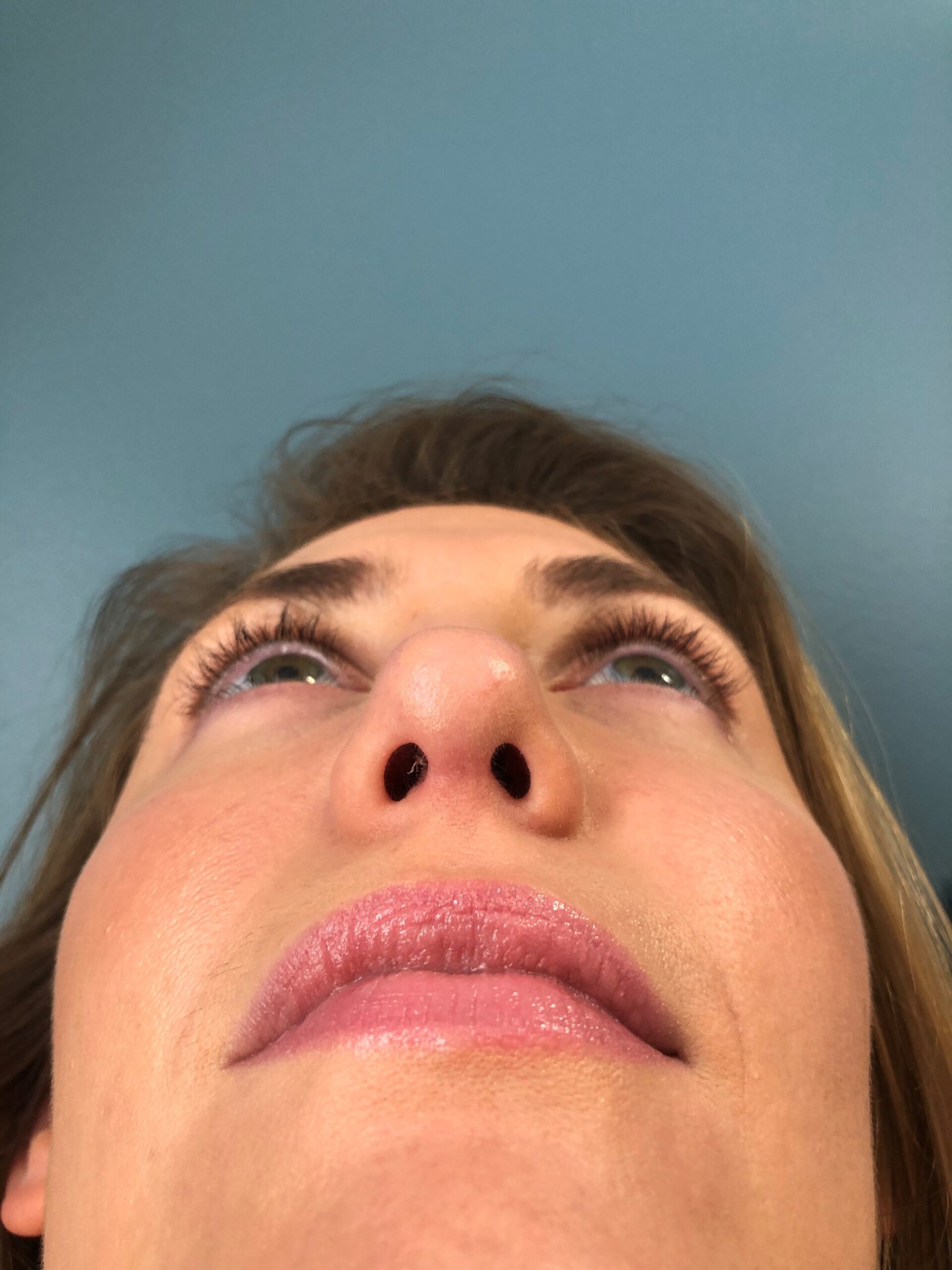 Rhinoplasty Patient Photo - Case 3103 - after view-0
