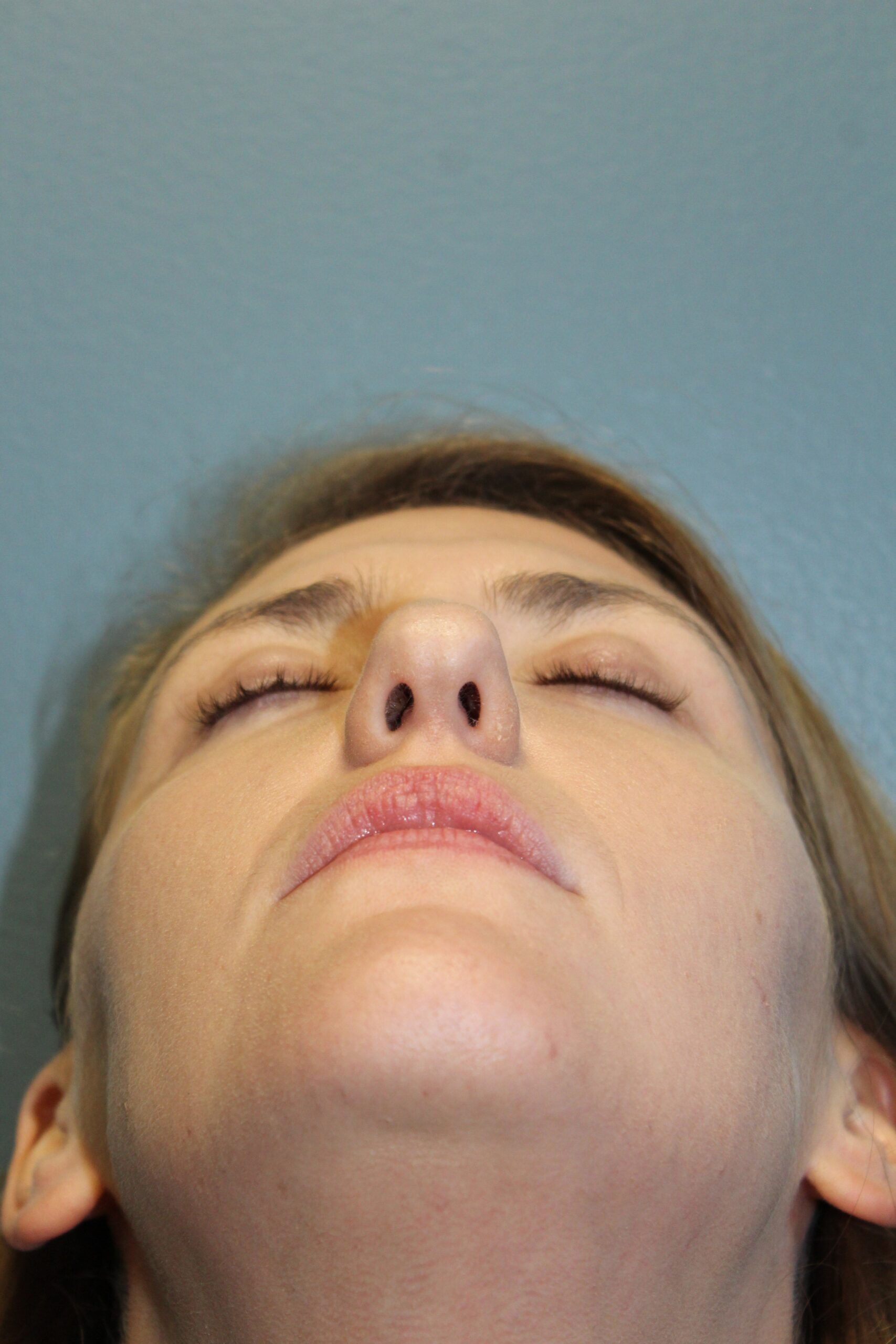 Rhinoplasty Patient Photo - Case 3103 - before view-0
