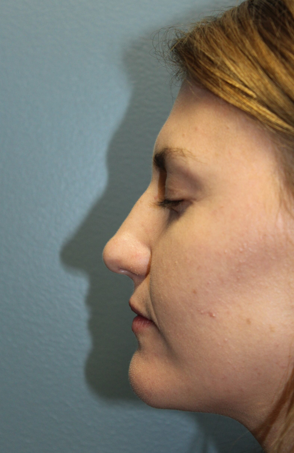 Rhinoplasty Patient Photo - Case 3106 - after view