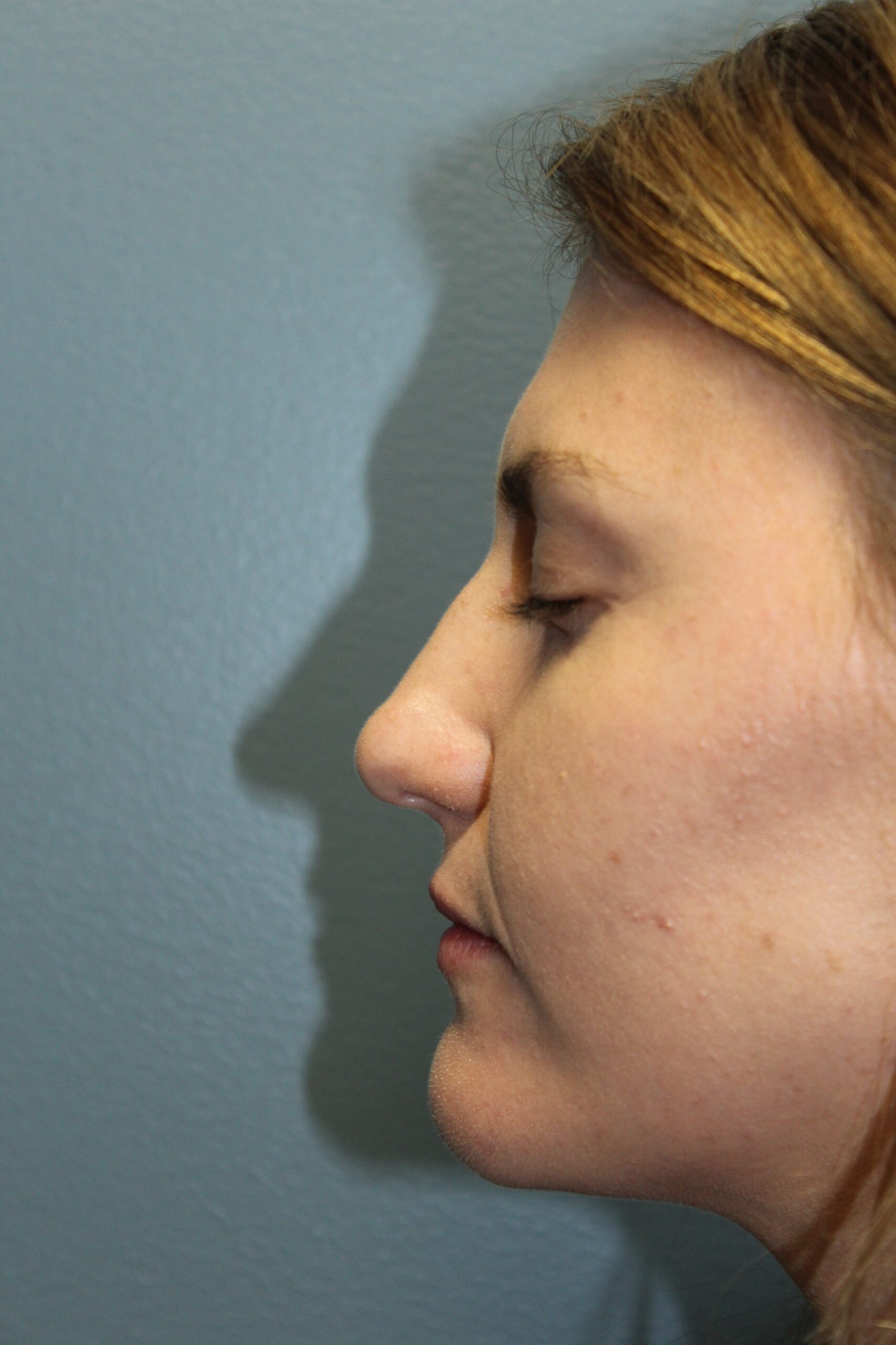 Rhinoplasty Patient Photo - Case 3106 - before view-0