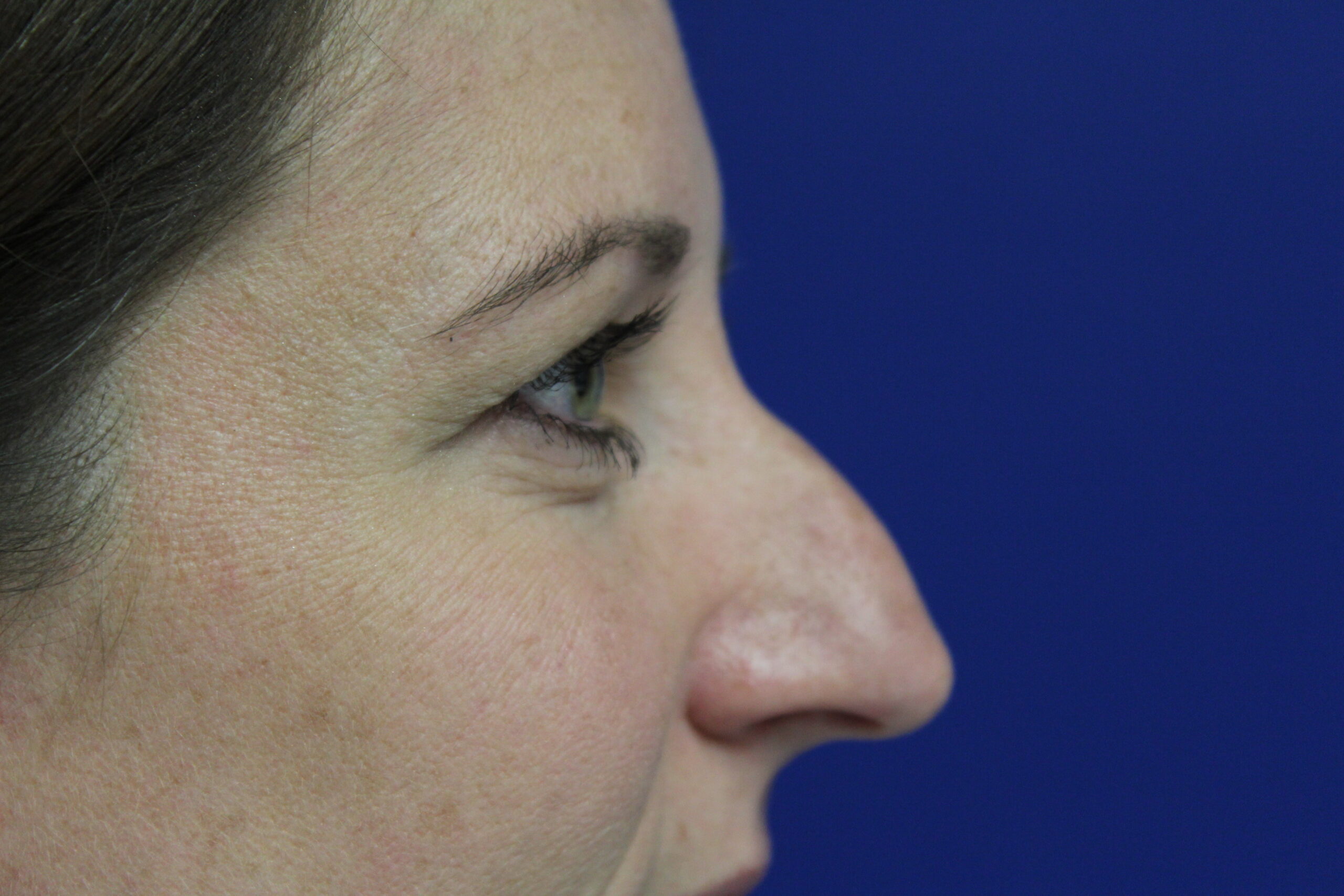 Rhinoplasty Patient Photo - Case 3109 - before view-0