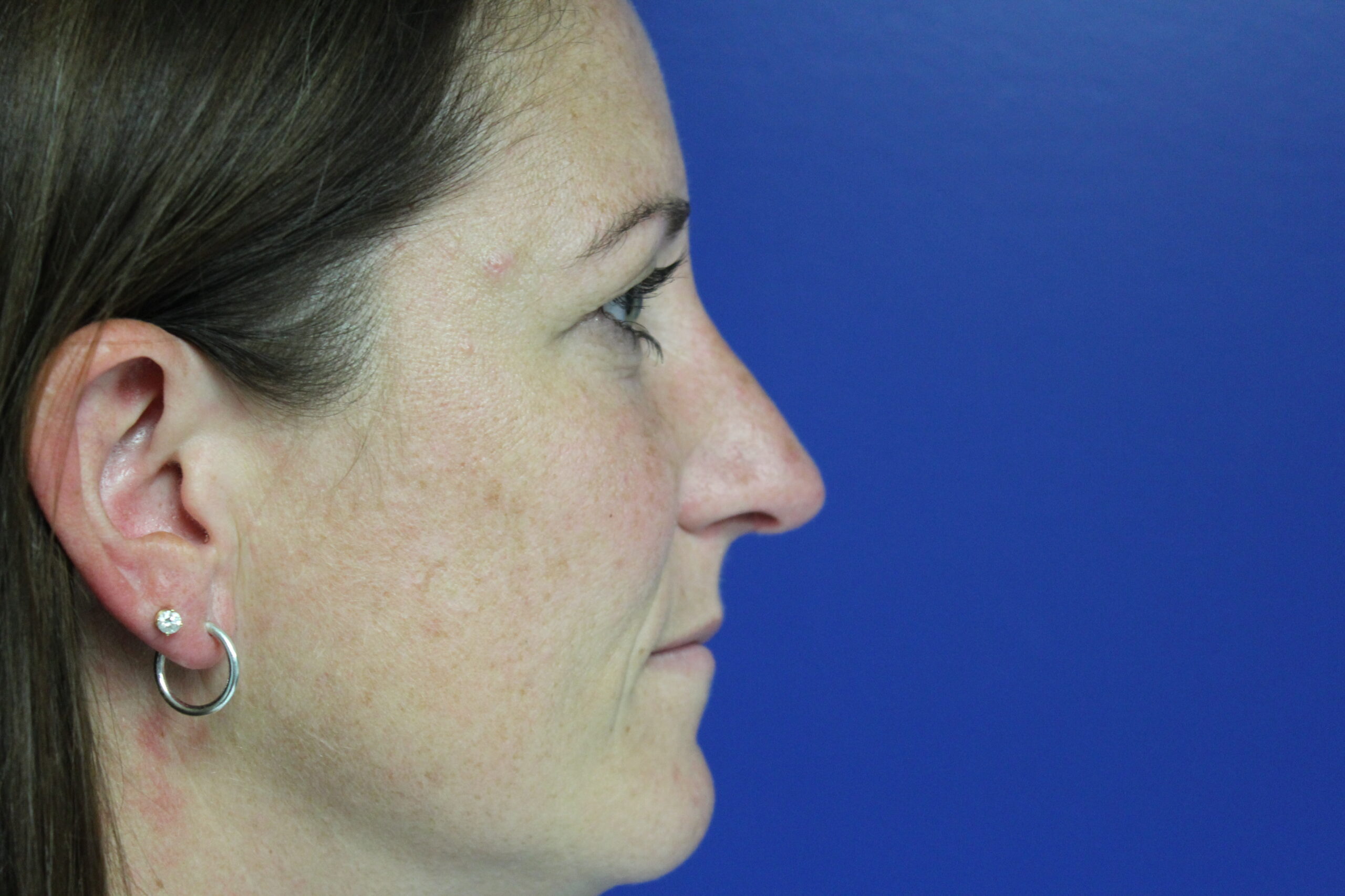 Rhinoplasty Patient Photo - Case 3109 - after view