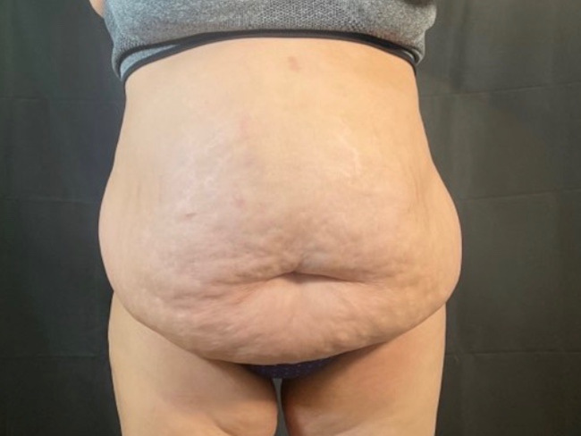 Tummy Tuck Patient Photo - Case 3116 - before view-