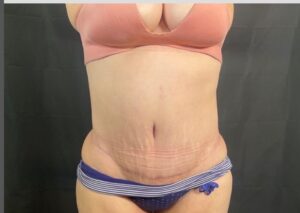 Tummy Tuck - Case 3116 - After