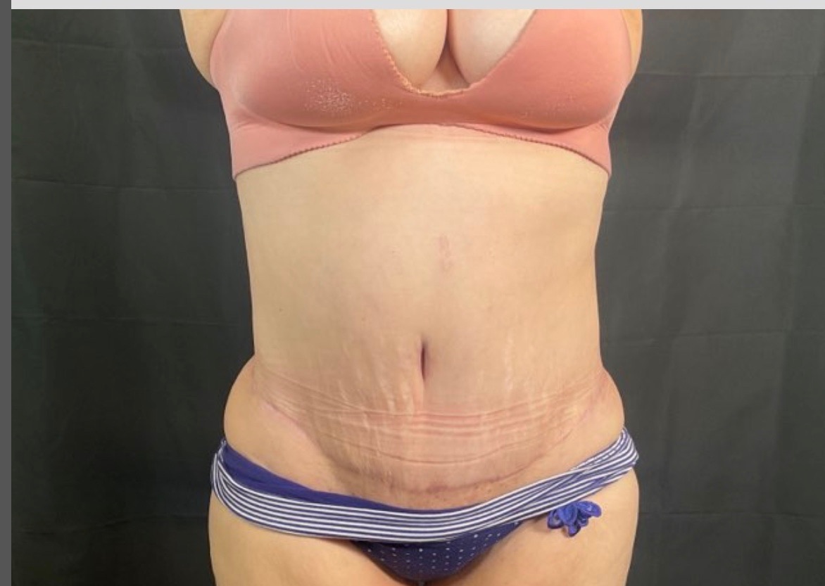 Tummy Tuck Patient Photo - Case 3116 - after view-0