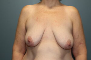 Breast Augmentation - Case 3132 - Before