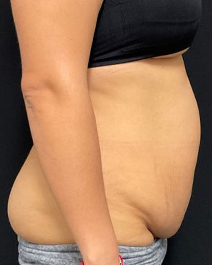 Tummy Tuck Patient Photo - Case 3190 - before view-2