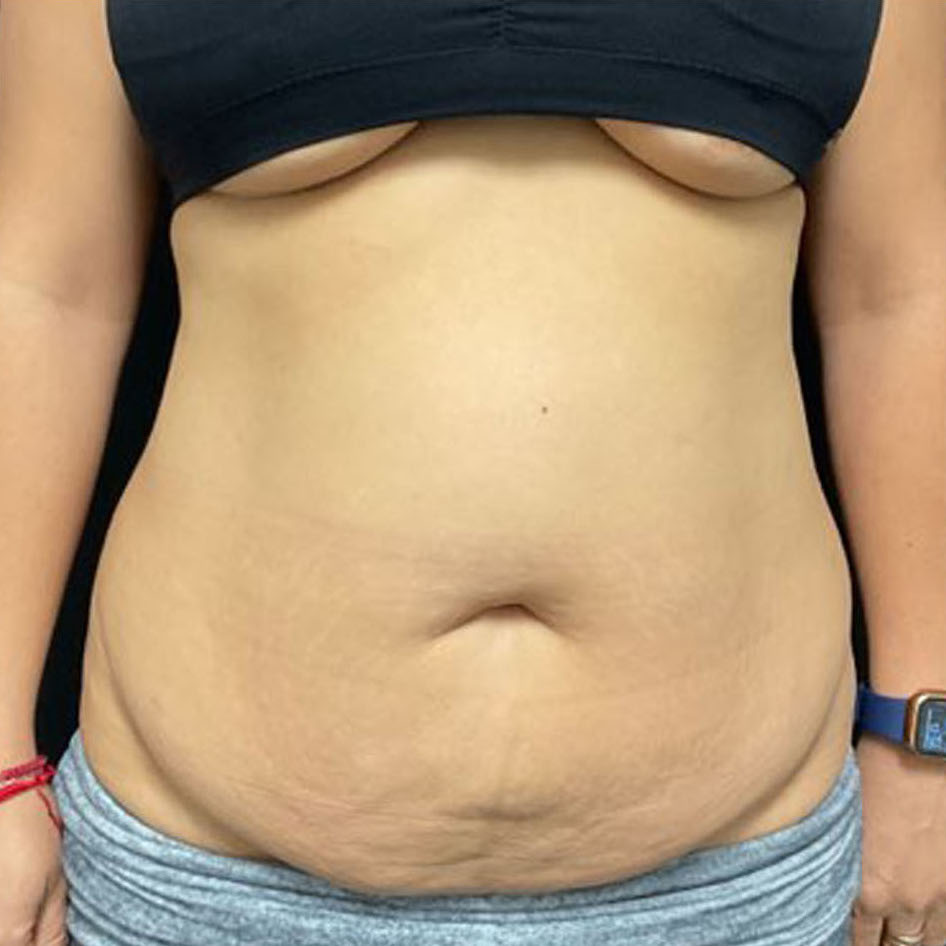 Tummy Tuck Patient Photo - Case 3190 - before view-0