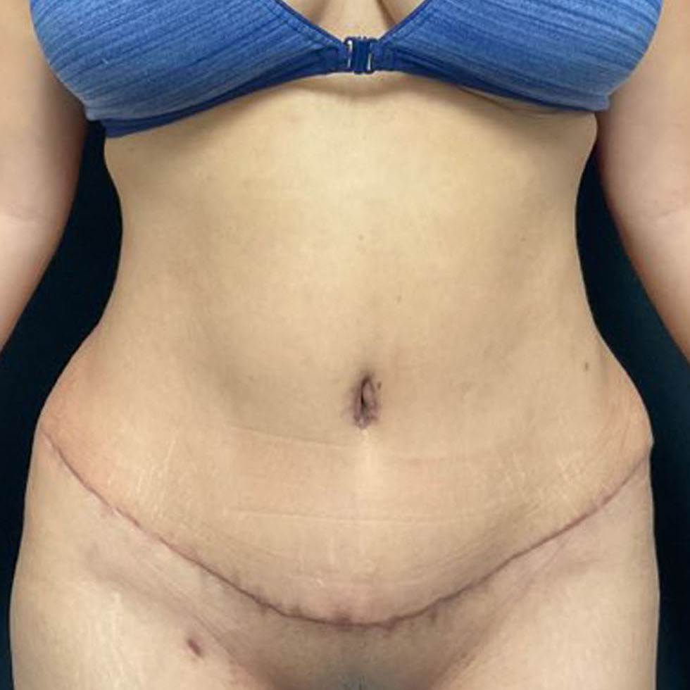 Tummy Tuck Patient Photo - Case 3190 - after view