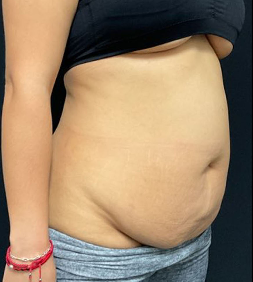 Tummy Tuck Patient Photo - Case 3190 - before view-1
