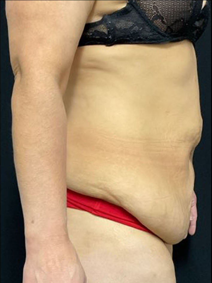 Tummy Tuck Patient Photo - Case 3197 - before view-2