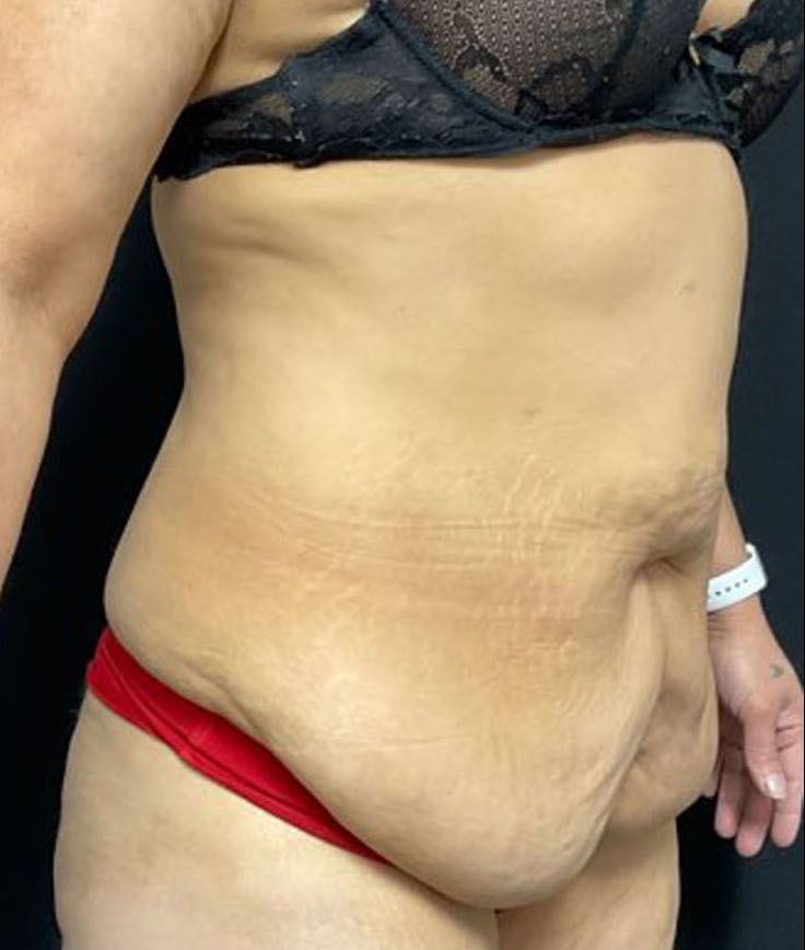 Tummy Tuck Patient Photo - Case 3197 - before view-1