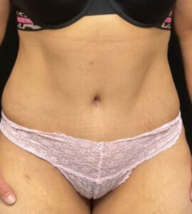 Tummy Tuck - Case 3197 - After