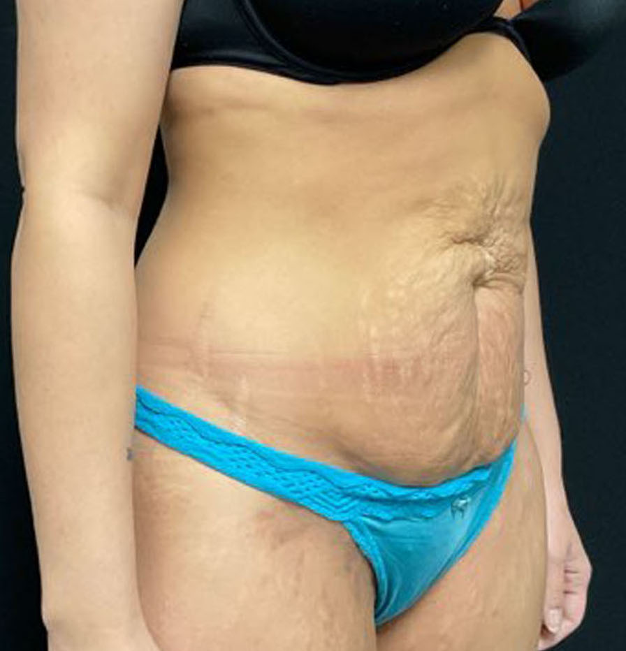 Tummy Tuck Patient Photo - Case 3204 - before view-1
