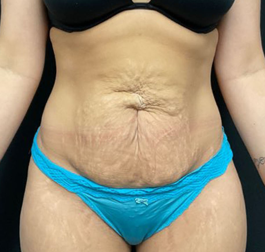 Tummy Tuck Patient Photo - Case 3204 - before view-