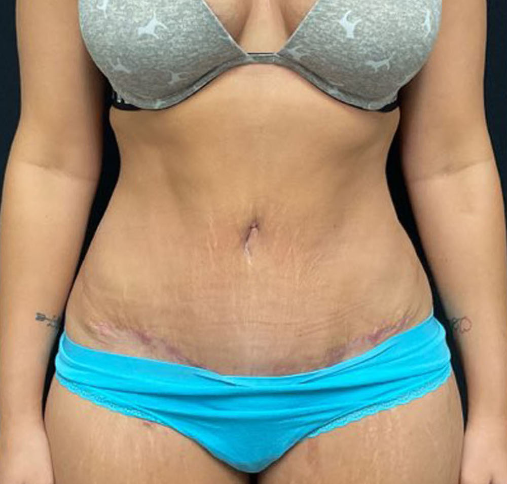 Tummy Tuck Patient Photo - Case 3204 - after view