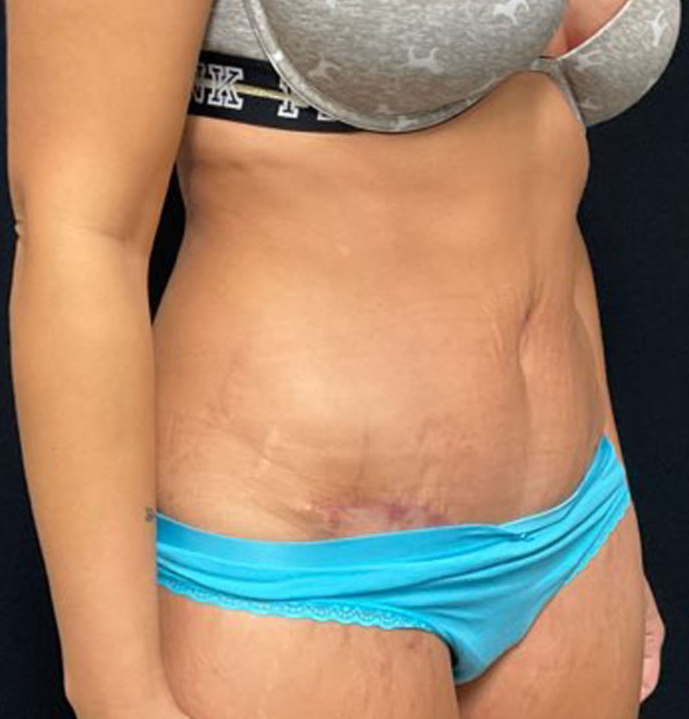 Tummy Tuck Patient Photo - Case 3204 - after view-1