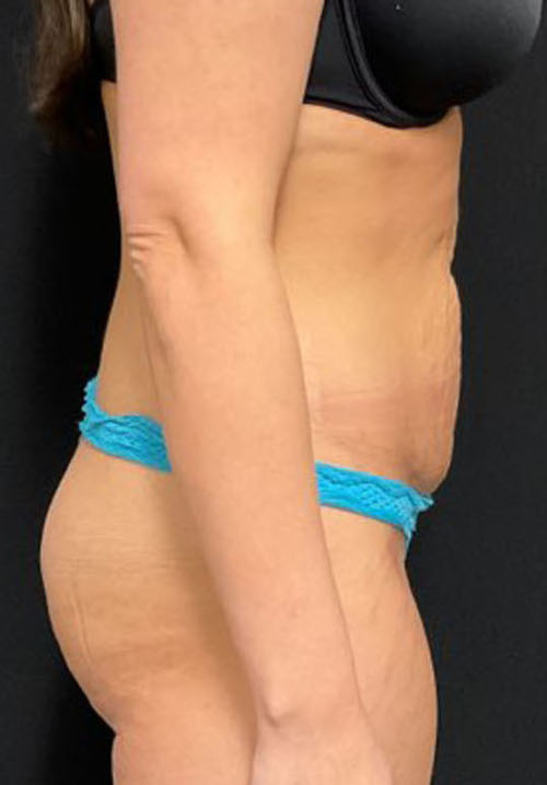 Tummy Tuck Patient Photo - Case 3204 - before view-2