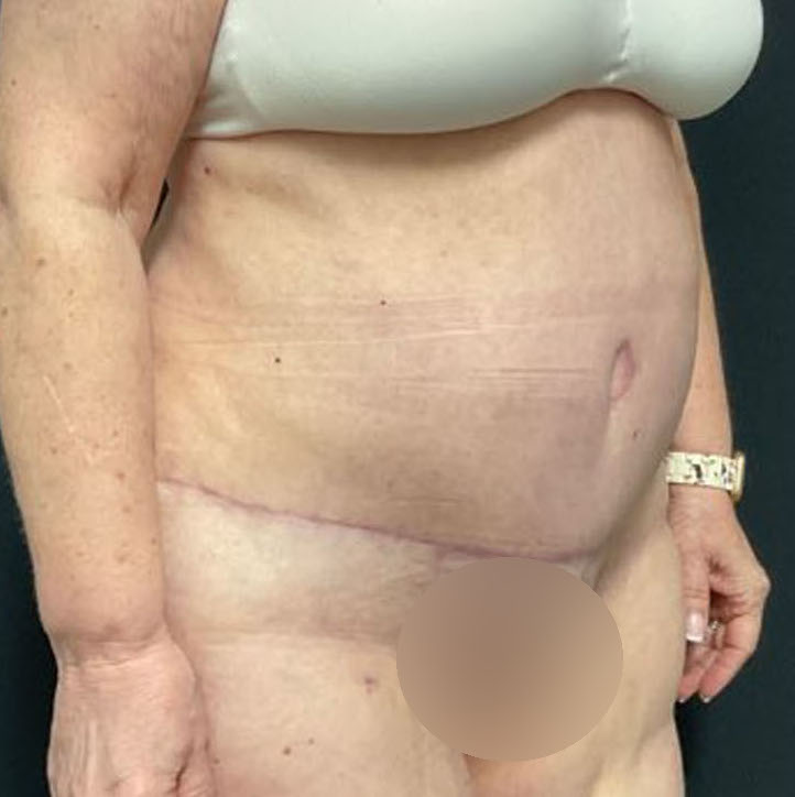 Tummy Tuck Patient Photo - Case 3211 - after view-1