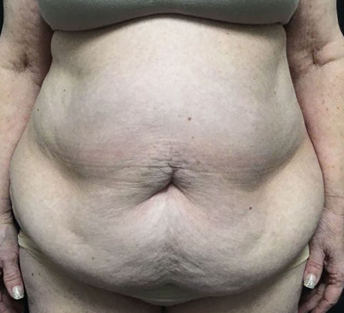 Tummy Tuck Patient Photo - Case 3211 - before view-
