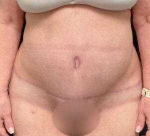 Tummy Tuck - Case 3211 - After