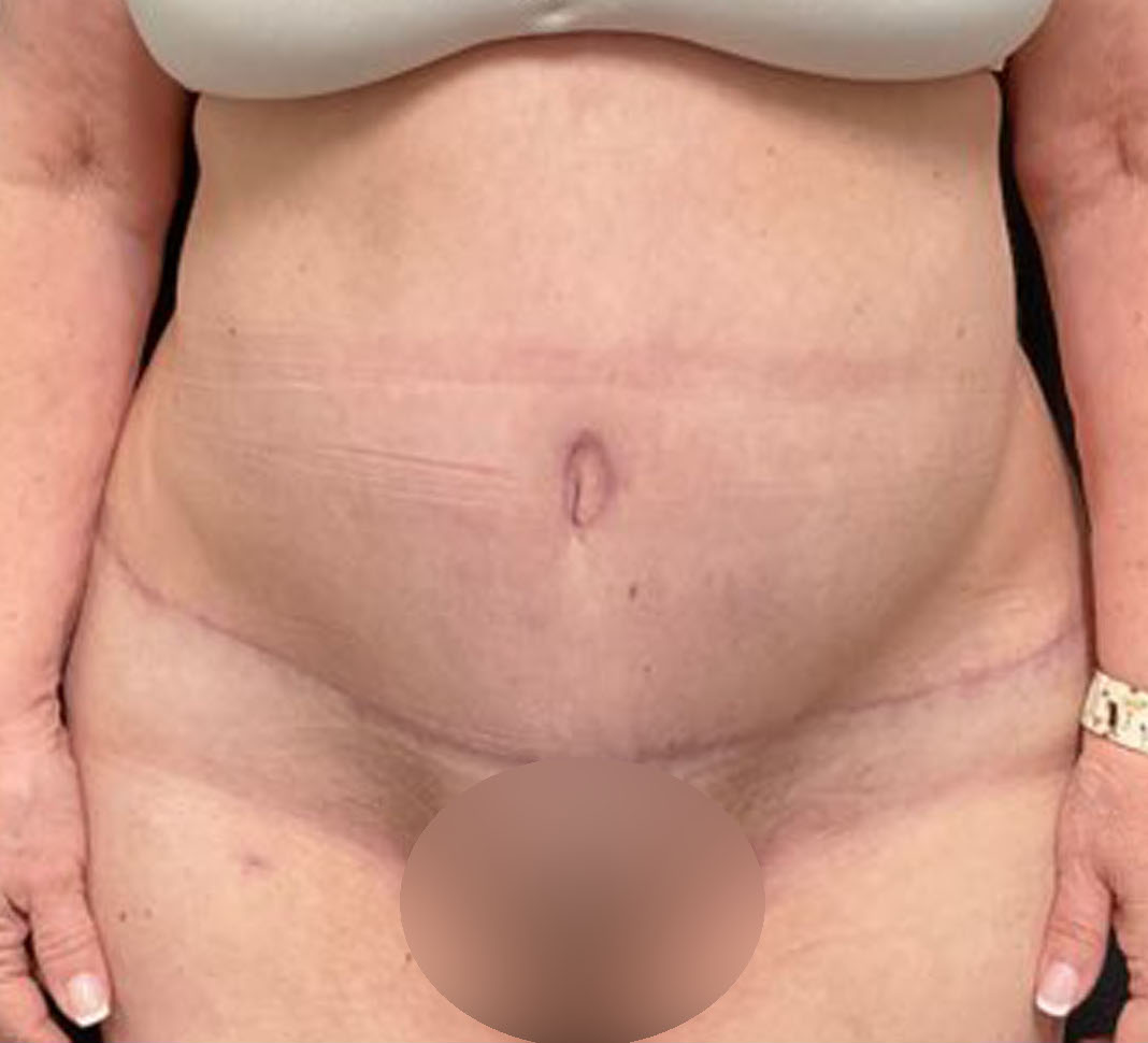 Tummy Tuck Patient Photo - Case 3211 - after view