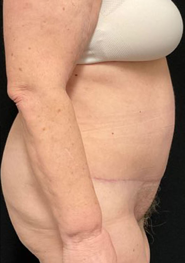 Tummy Tuck Patient Photo - Case 3211 - after view-2