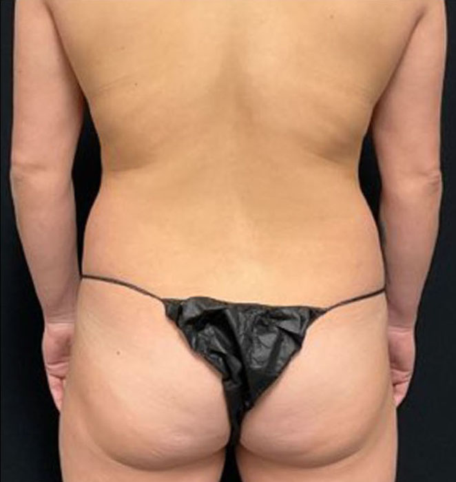 Liposuction Patient Photo - Case 3269 - before view-3