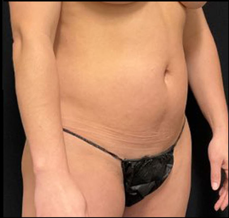 Liposuction Patient Photo - Case 3269 - before view-1