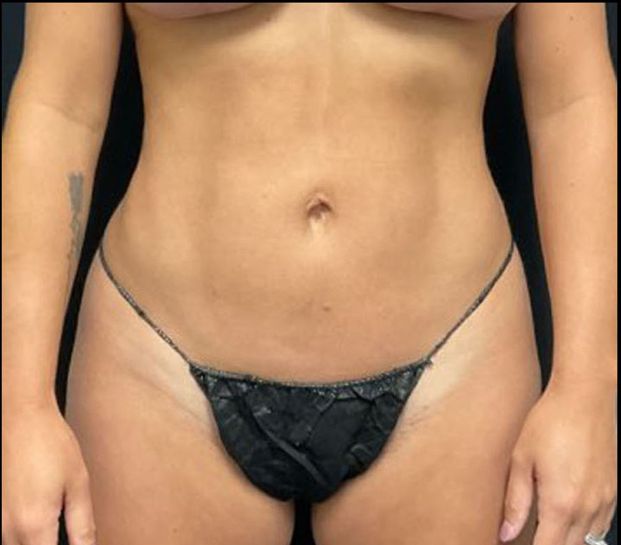 Liposuction Patient Photo - Case 3269 - after view