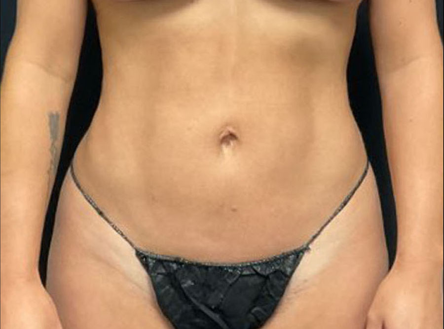 Liposuction Patient Photo - Case 3269 - after view