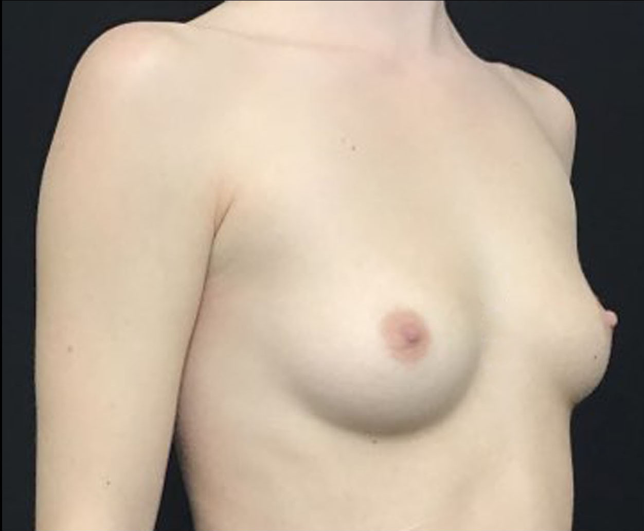 Breast Augmentation Patient Photo - Case 3300 - before view-1