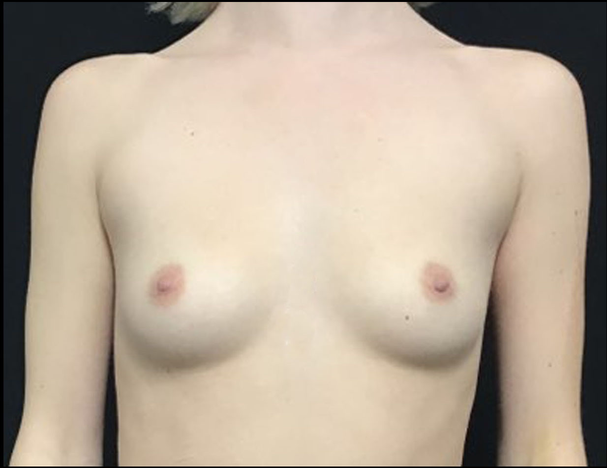 Breast Augmentation Patient Photo - Case 3300 - before view-0