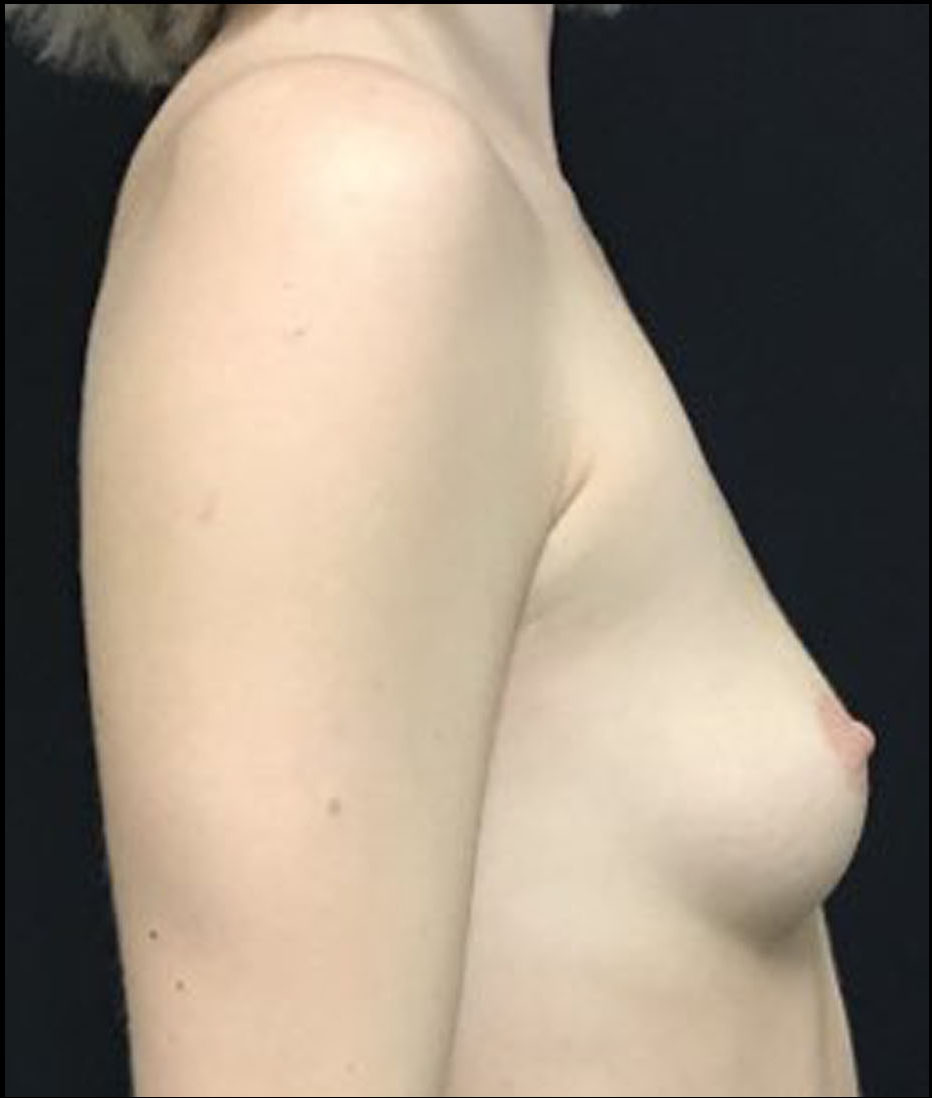Breast Augmentation Patient Photo - Case 3300 - before view-2