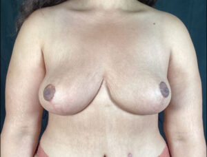 Breast Lift - Case 3438 - After
