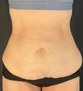 Liposuction - Case 3441 - Before