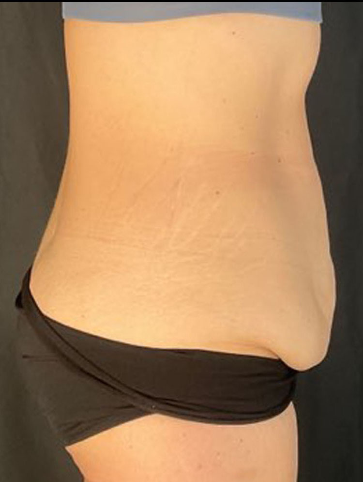 Liposuction Patient Photo - Case 3441 - before view-2