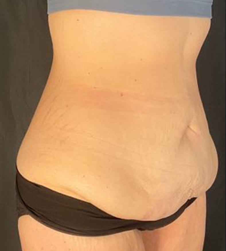 Liposuction Patient Photo - Case 3441 - before view-1