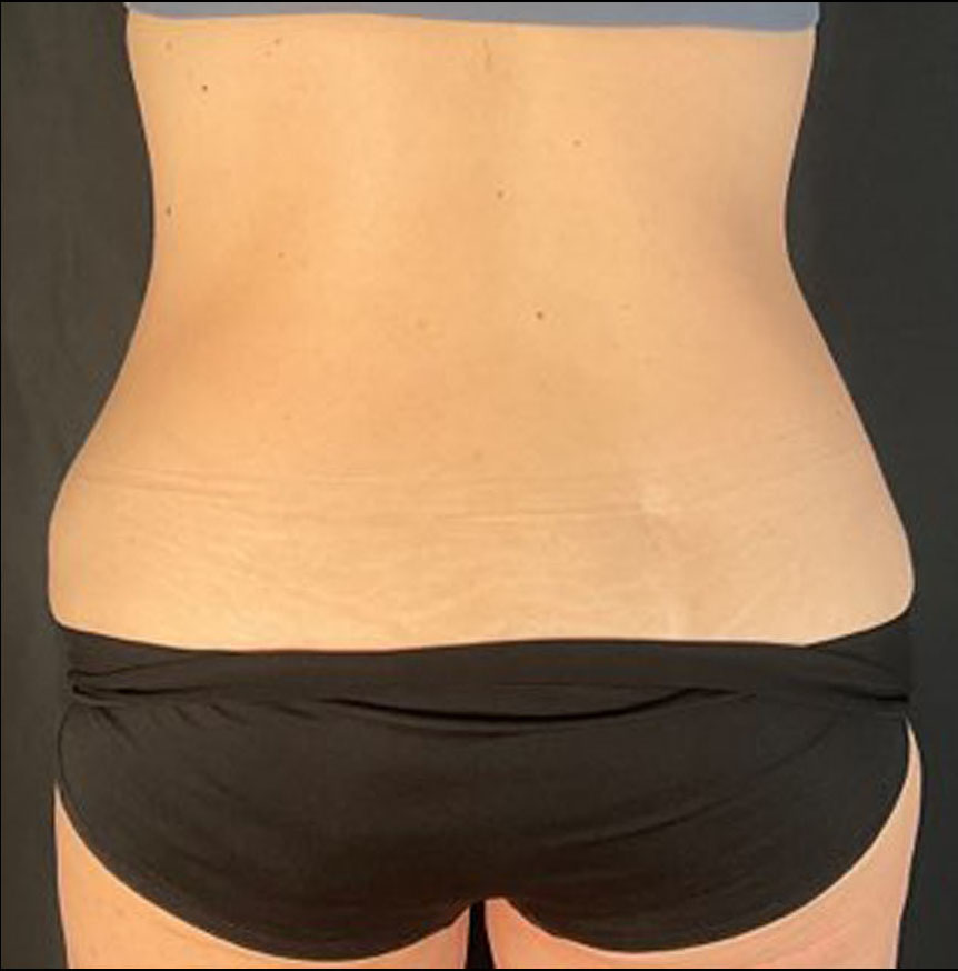 Liposuction Patient Photo - Case 3441 - before view-3