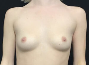 Breast Augmentation - Case 3460 - Before