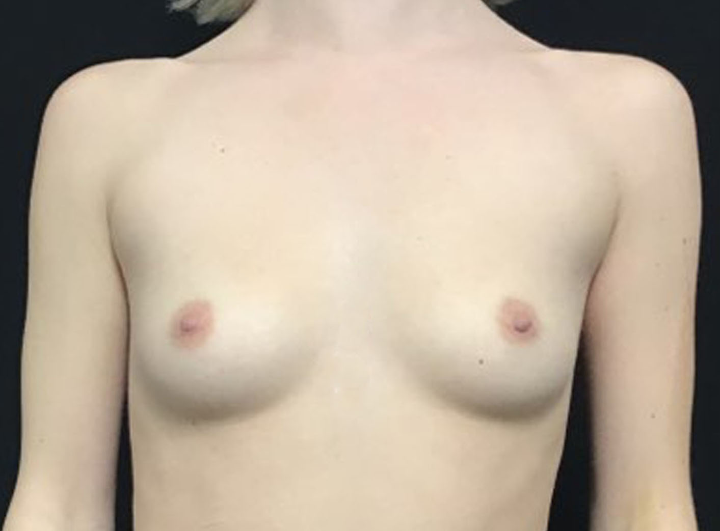 Breast Augmentation Patient Photo - Case 3460 - before view-0