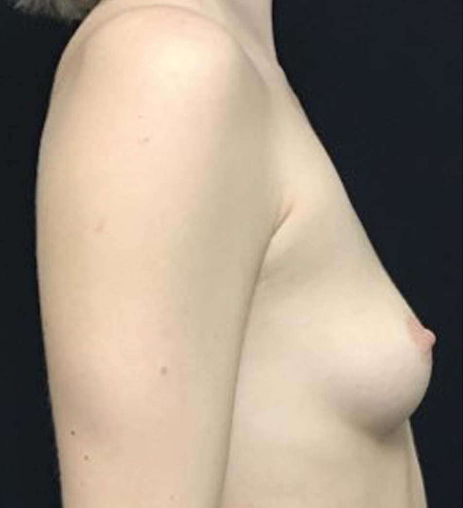 Breast Augmentation Patient Photo - Case 3460 - before view-1