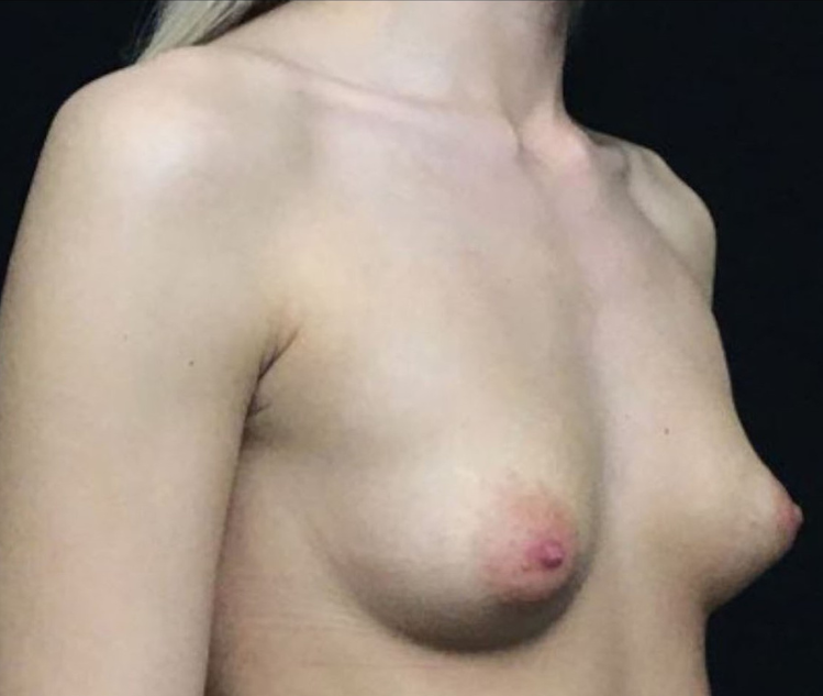 Breast Augmentation Patient Photo - Case 3463 - before view-1