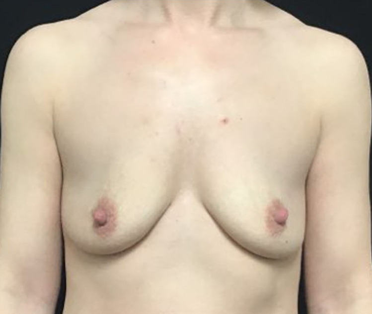 Breast Augmentation Patient Photo - Case 3466 - before view-0